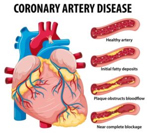 Coronary Artery Disease is a type of Heart disease.
