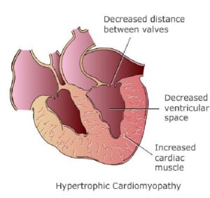 Hypertensive Heart disease causes change in structure of heart wall.