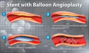 Steps followed in Angioplasty procedure.
