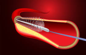 Baloon like structure get used during Angioplasty.