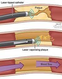 Steps followed in Laser Angioplasty