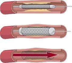 Steps in Stent Angioplasty