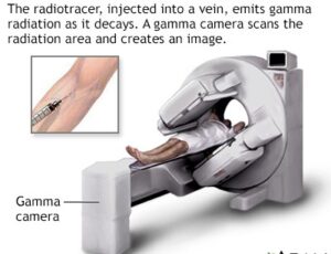 Nuclaear Stress Test is one of the useful test to diagnose CAD.