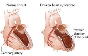 Anatomical changes due to Broken Heart Syndrome