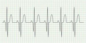 Electrocardiogram on  ECG paper