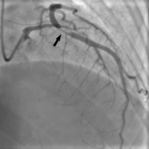 Spontaneous Coronary Artery Dissection (SCAD) could develop during pregnancy.