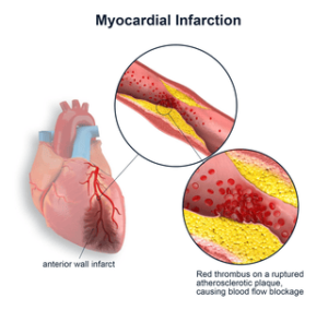 Myocardial Ischemia could develop during pregnancy.